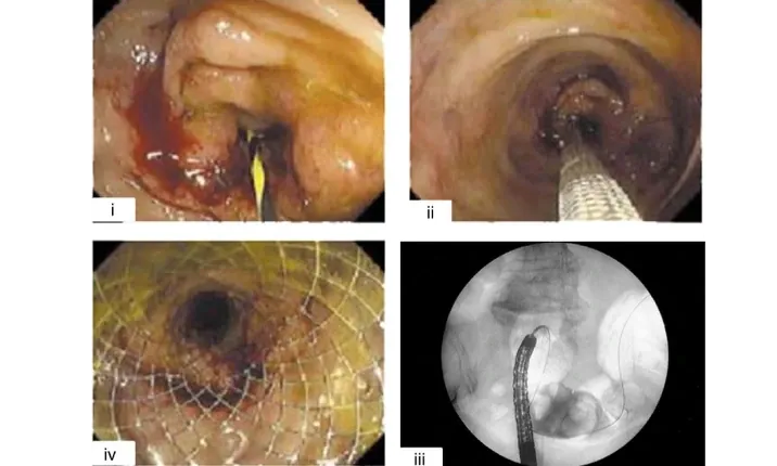 Colonic Stenting training