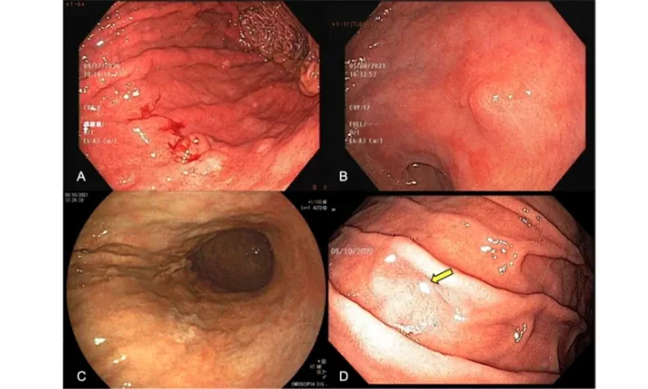 Diagnostic Upper Endoscopy training