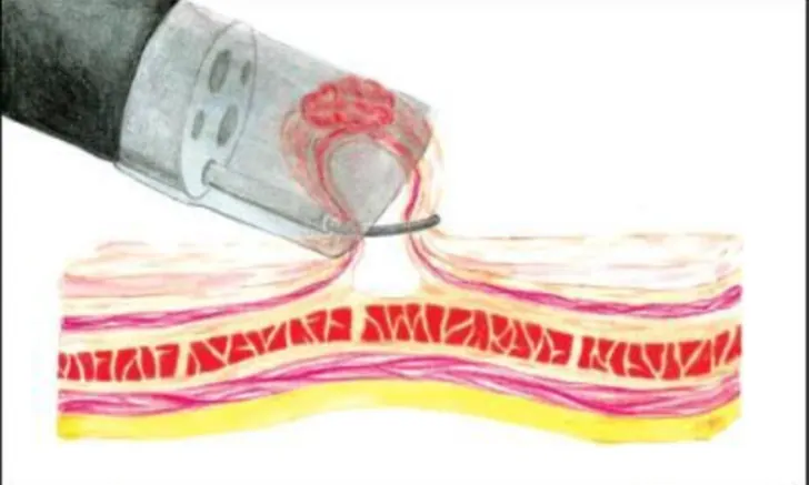 Endoscopic Mucosal Resection (EMR) training