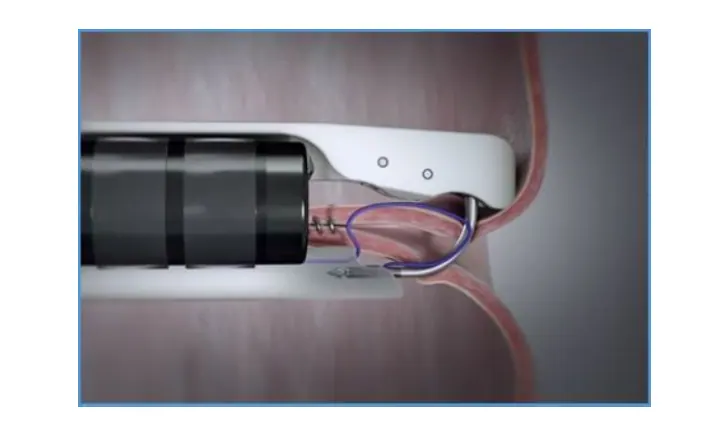 Endoscopic Management of Perforation training