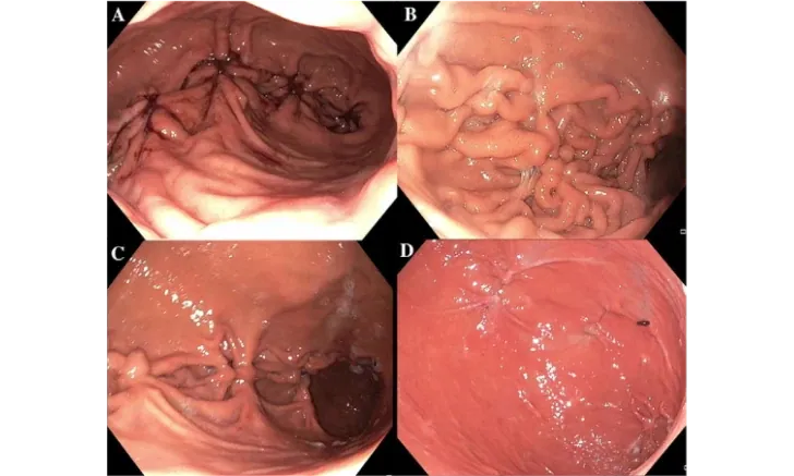 Endoscopic Sutured Gastroplasty training