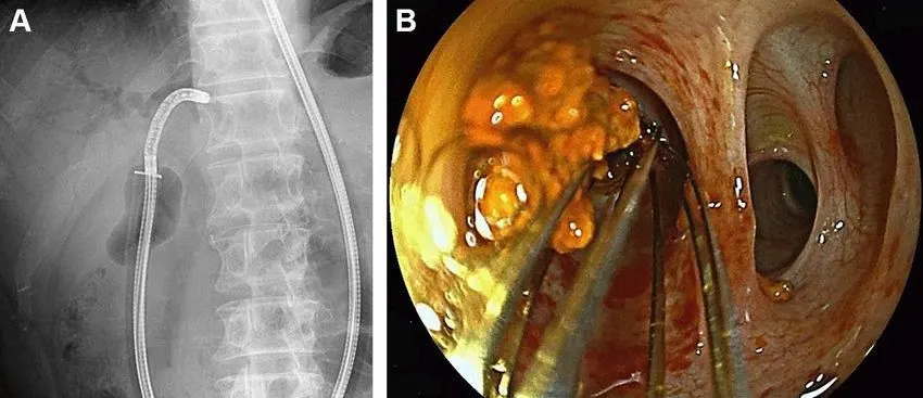 Cholangioscopy training