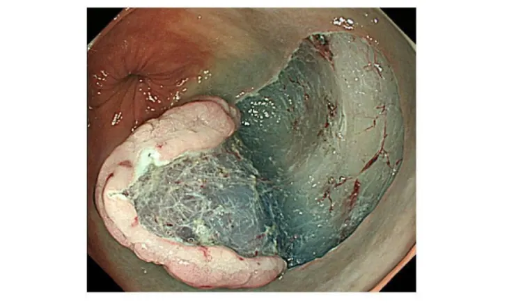 Endoscopic Submucosal Dissection (ESD) training