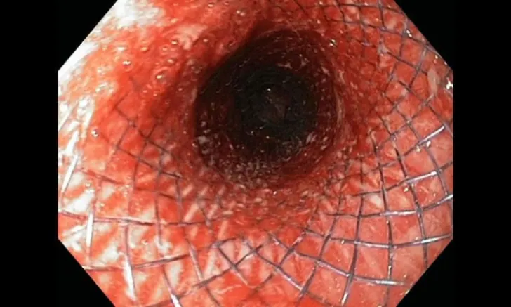Esophageal and Duodenal Stenting training