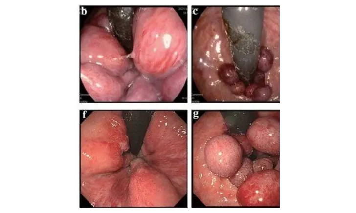Internal Hemorrhoids Band Ligation training
