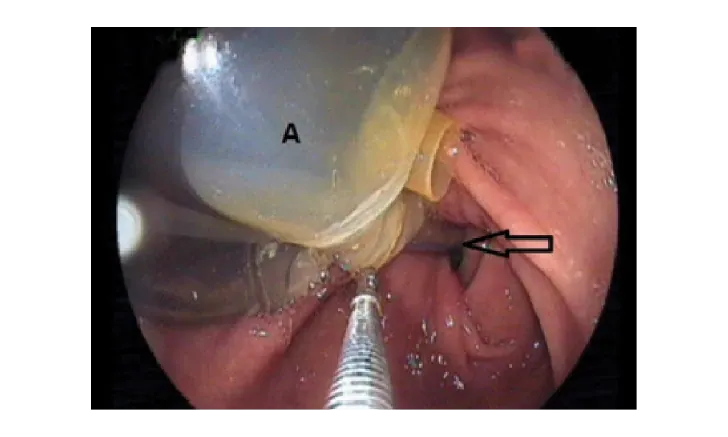 Intragastric Balloon Insertion training