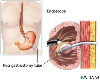 Percutaneous Endoscopic Gastrostomy (PEG) training