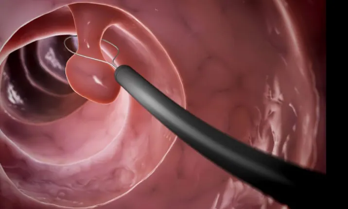 Polypectomy training