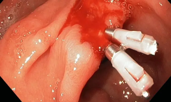Ulcer Bleeding Control training